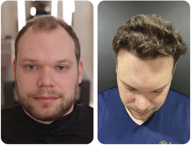 antes-depois1