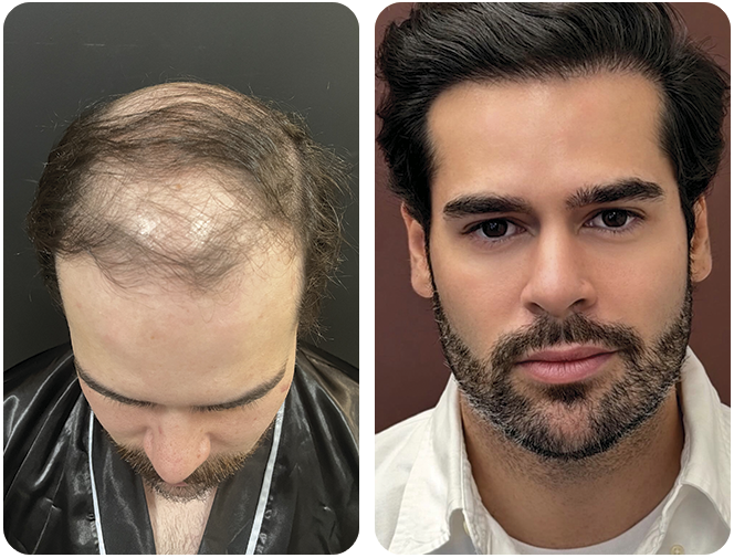 antes-depois3