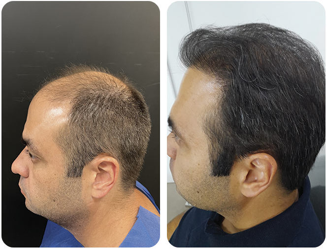 antes-depois5